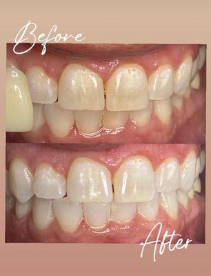 Check out this amazing transformation! look the before and after of our teeth whitening treatment. Bright smiles are here! Book now!