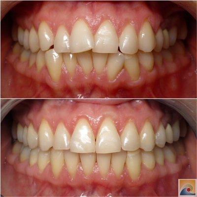 Clear Aligners can straighten out that beautiful smile