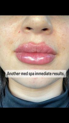 Immediately after getting my lips done at another med spa.