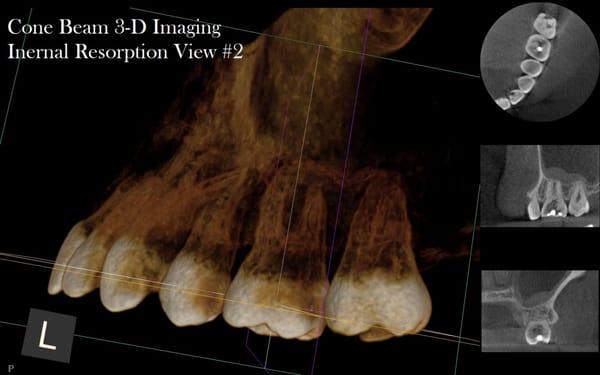 Second view of a Cone Beam 3-D image of Internal Root Resorption