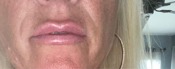 1 full syringe of lip filler