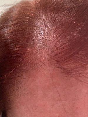 Bald patch - hair cut gone bad at Supercuts