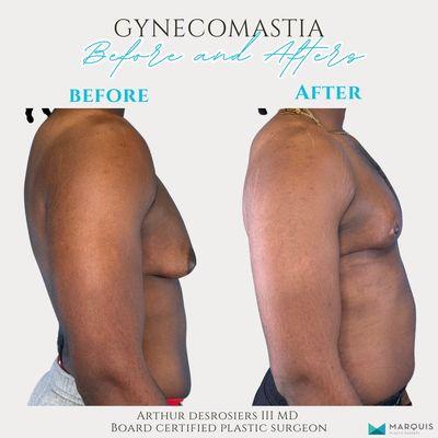 Gynecomastia (male breast reduction)