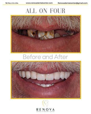 Full Mouth Rehabilitation with Dental Implants