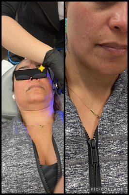 Process and after flow of a hydrofacial. Ask for Tina