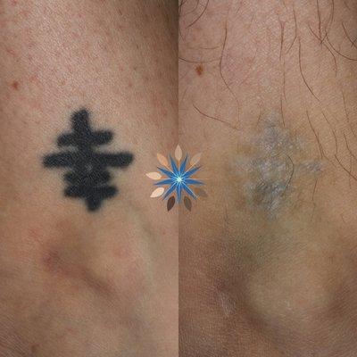 Laser Tattoo Removal