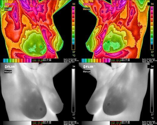 Radiant Body Thermography