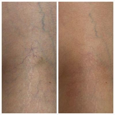 Spider Vein Removal - before and after