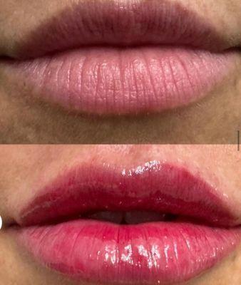 lip filler before and after for a natural plump