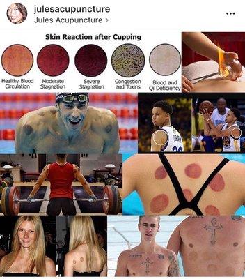 Everybody's gettin cupped!  Recover faster, perform better. Try cupping.