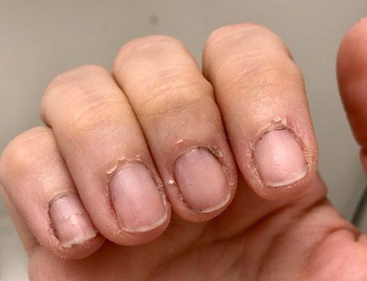 What happens to me when cuticles are yanked when cut. Pls don't do this to others. *disregard the blk polish, that's the work of my 11yr old