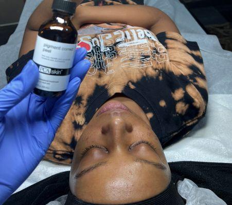 Chemcial peel to get rid of hyperpigmentation