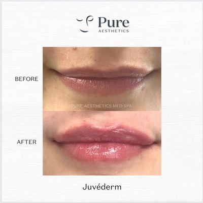 Filler at Pure Aesthetics