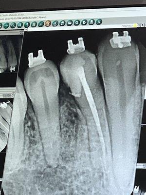 Sealed root canal