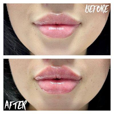 Beautiful lip filler special  $299