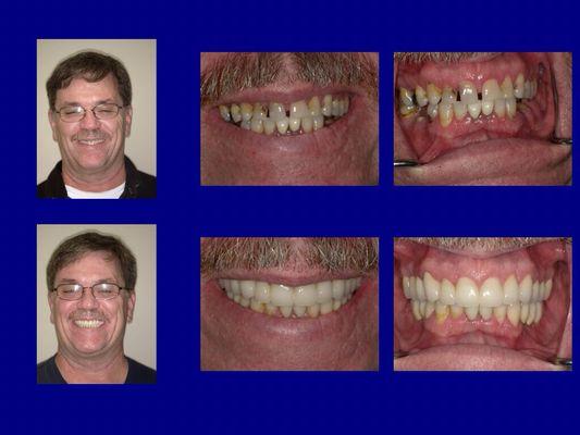 Before & After of actual patients of Dr Thomas Williams .  www. thwilliams.com, phone 334-277-9570