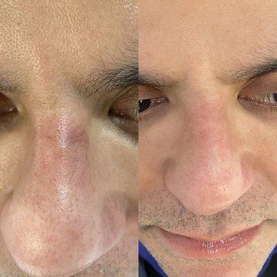 One sclerotherapy treatment to facial spider veins on nose.