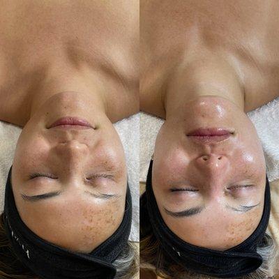 Before and After Hydrafacial