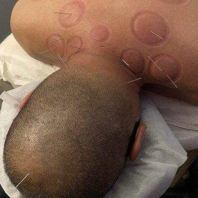 Acupuncture treatment for neck and shoulder tension.