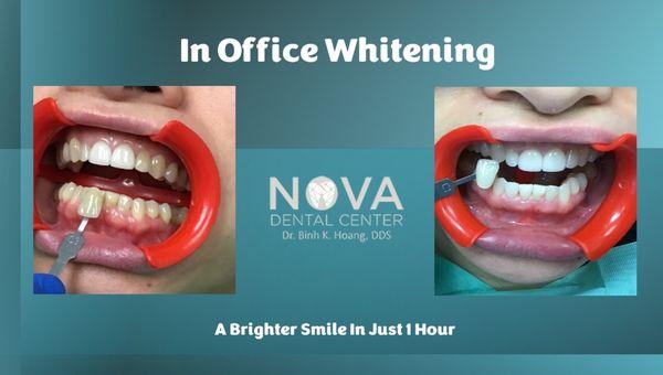 Teeth Whitening