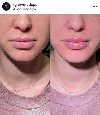 iGlowMedSpa Porter Ranch - Lip Injections Restylane Kysse