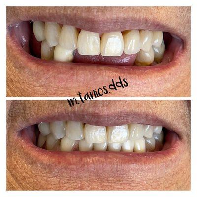 Replacing missing teeth with a comfortable, flexible and aesthetically pleasing partial denture.