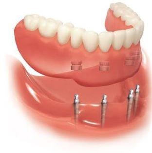 Mini Dental Implant Stabilized Denture