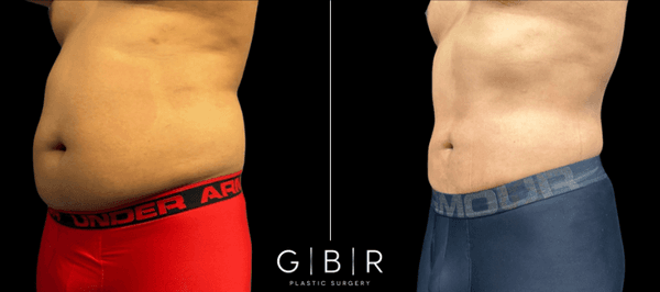 Male Liposuction by Galardi Bowen Plastic Surgery