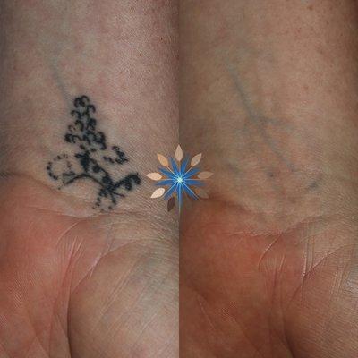 Laser Tattoo Removal