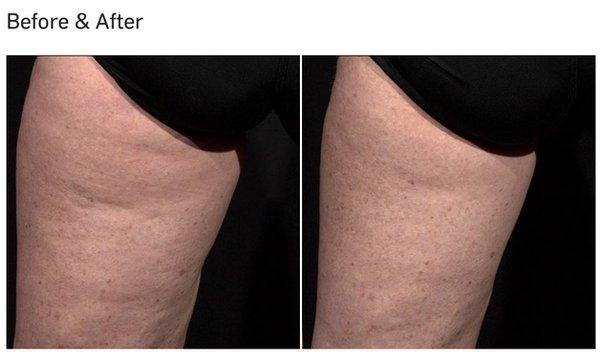 Cellulite Reduction with TempSure