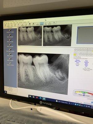 socket with part of a tooth and exposed nerves left behind