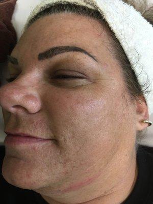 Hyper pigmentation and acne scarring on 3rd microneedling session final picture to come  Excellent results