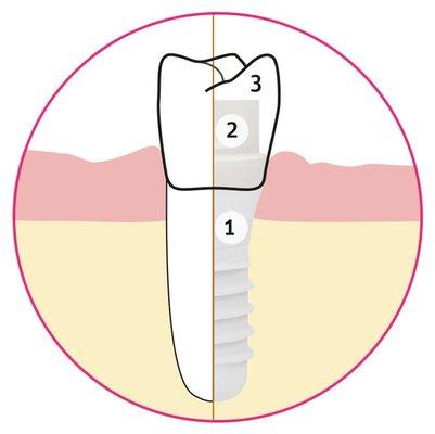 We provide biologic metal-free ceramic implants