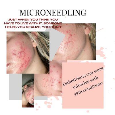 Second Treatment of Microneedling