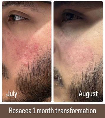 Rosacea 1 month transformation