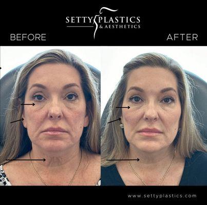 Patient was treated with Juvéderm filler to cheeks, jawline, and chin, as well as Botox to platysmal neck bands.