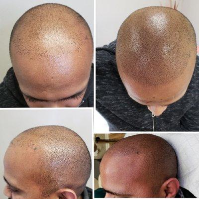 Before and After his SMP (scalp micropigmentation)