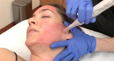 Microneedling