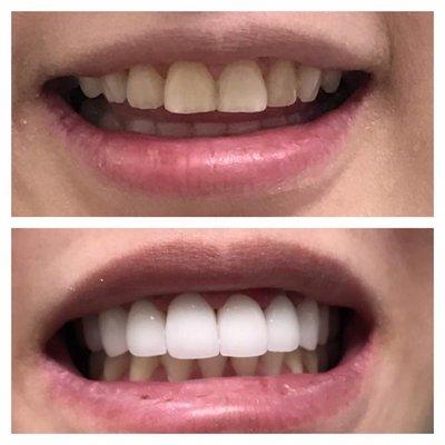 Upper cosmetic crowns before&after