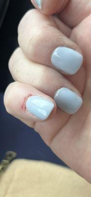 Pinkie finger cuticle wound