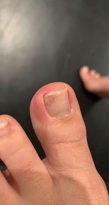 ingrown nail & infection.