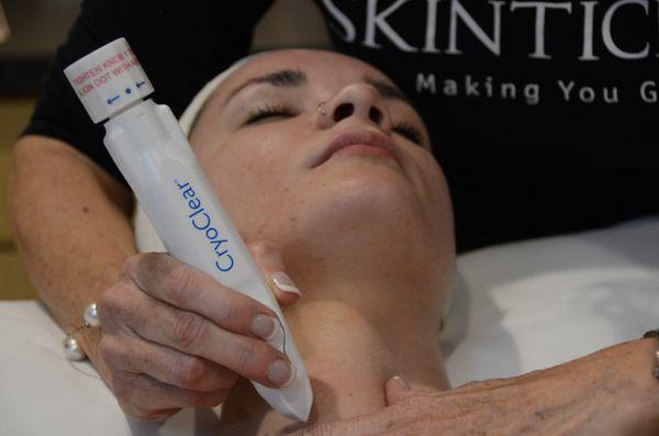 Cryotherapy. Remove skin tags and brown spots.