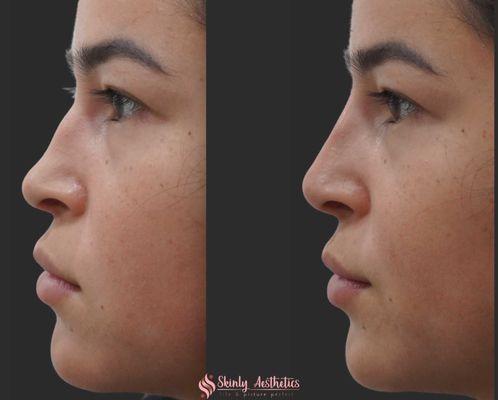 27 year old female post nose filler injections to straighten the bridge of the nose and lift the tip of the nose with 1 syringe of Juvederm