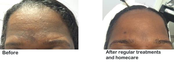 Pigmentation Treatment