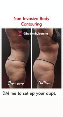 Lypossage: Non - Invasive Body Contouring