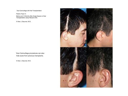 Scar coverage using FUE hair transplantation.