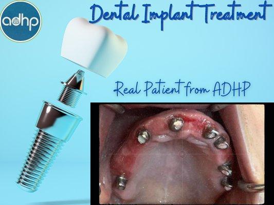 Dental Implants done by ADHP recently.