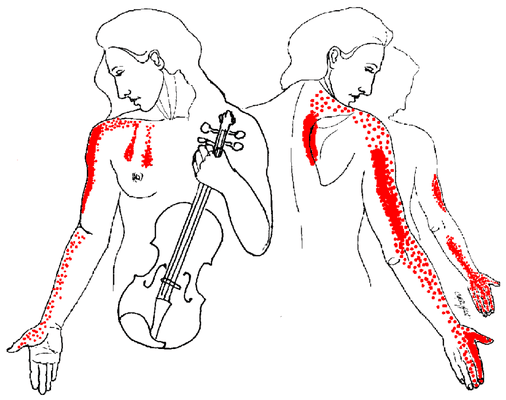 Pain Patterns Caused From Trigger Points in the Neck