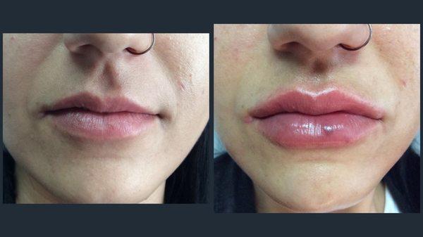 lip filler before and after