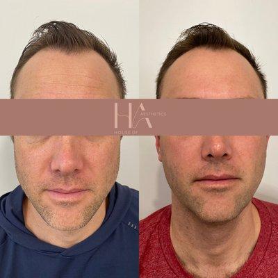 Botox to forehead and masseters for TMJ and can help with jaw line slimming